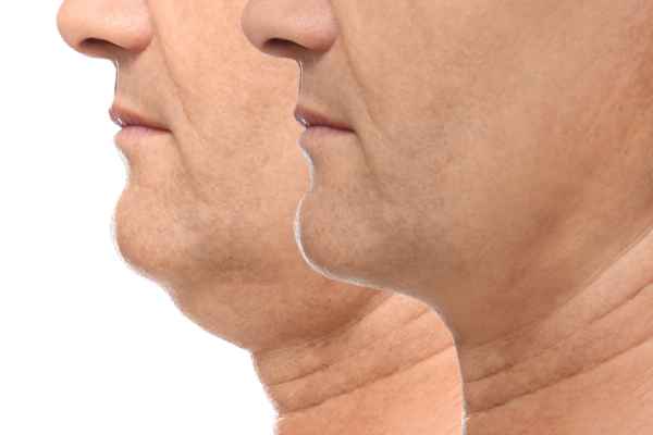 HIFU - Breakthrough in Anti - ageing 2 hifu results Sevenoaks