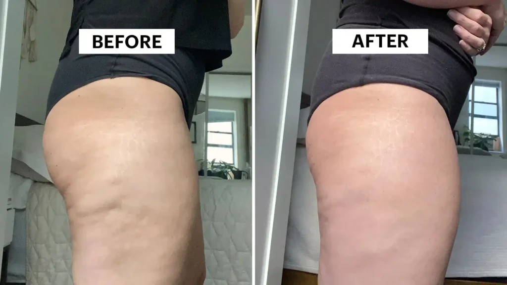 Do Toning Exercise Sevenoaks Really Tackle Cellulite?