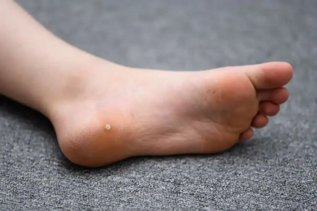 Cryotherapy For Warts And Also Verrucas 2 Image of verruca on the bottom of the foot that able to be treated with Cryotherapy Sevenoaks