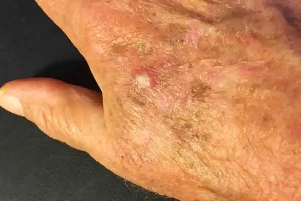 Image of Actinic keratoses Sevenoaks on a person hand