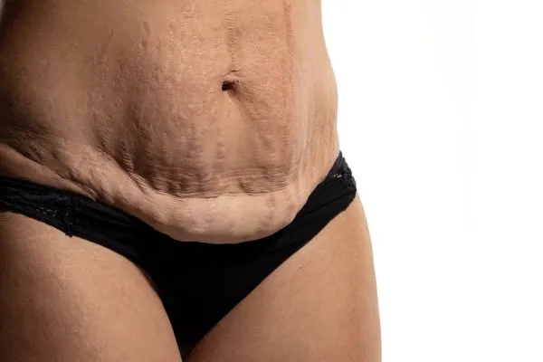 The science behind skin tightening Sevenoaks picture of a woman's sagging skin on the stomach